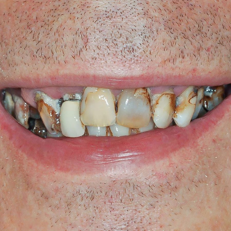 smile in a day 4 before